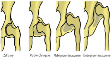 Zásady správnej stabilizácie pacientov s posturálnym deficitom v stoji