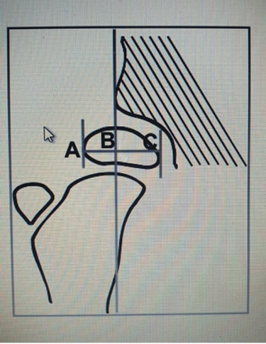 Zásady správnej stabilizácie pacientov s posturálnym deficitom v stoji